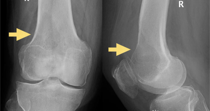 Resección oncológica- Radiografia de metástasis de cáncer renal _Dr Roberto Vélez