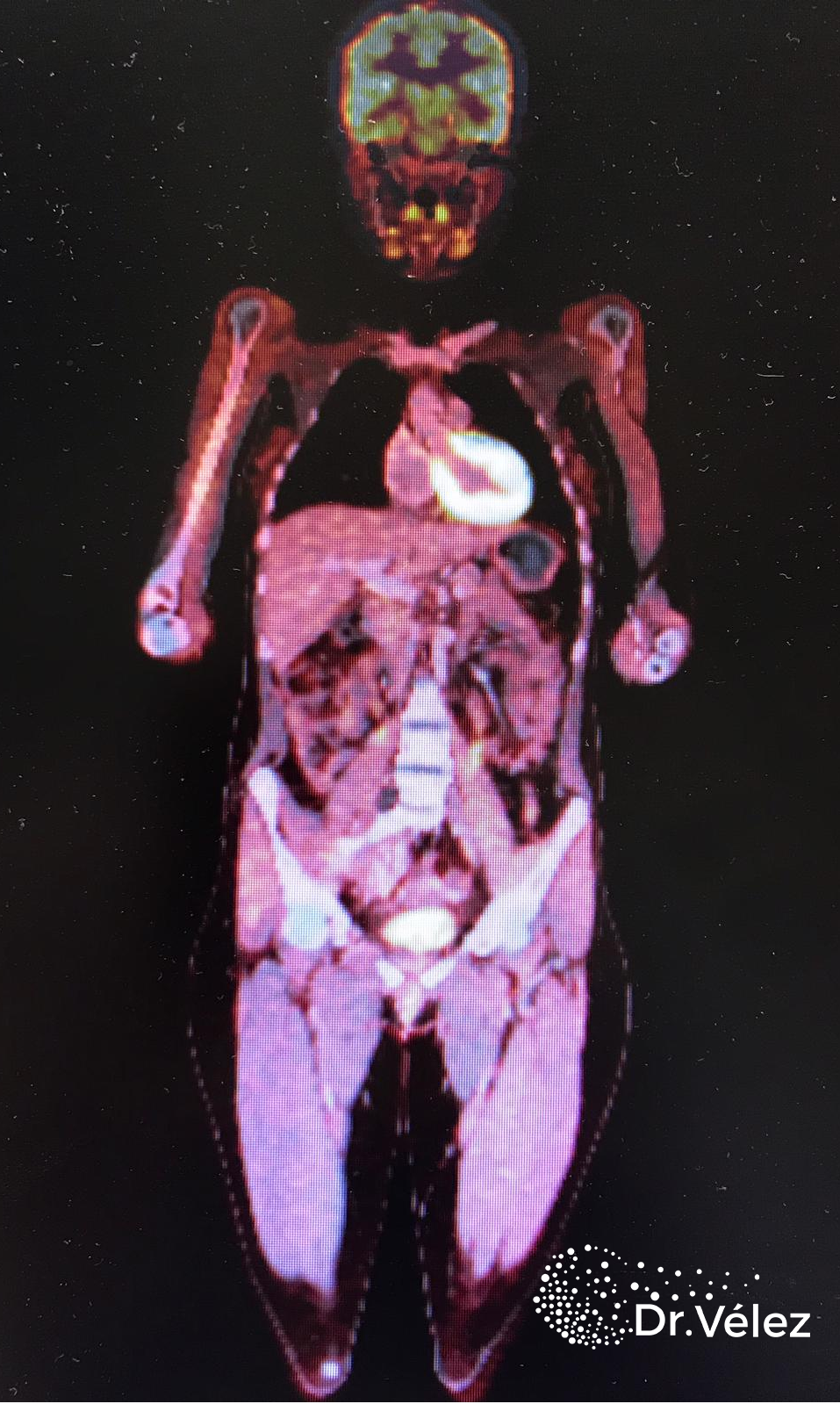 estudio de extensión PET TAC normal_ DR Roberto Vélez