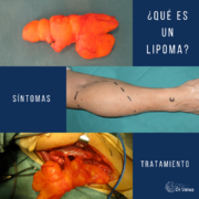 ¿Qué es un lipoma?