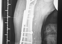 Sarcoma de Ewing diafisario de fémur derecho