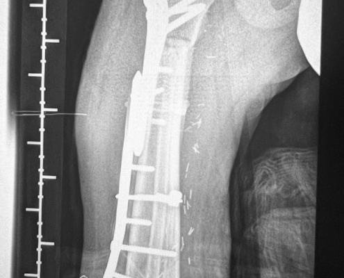 Sarcoma de Ewing diafisario de fémur derecho