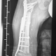 Sarcoma de Ewing diafisario de fémur derecho