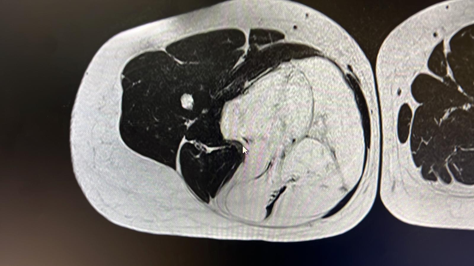 Liposarcoma: Qué es, tipos y tratamiento - dr roberto