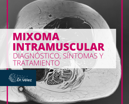 mixoma intramuscular