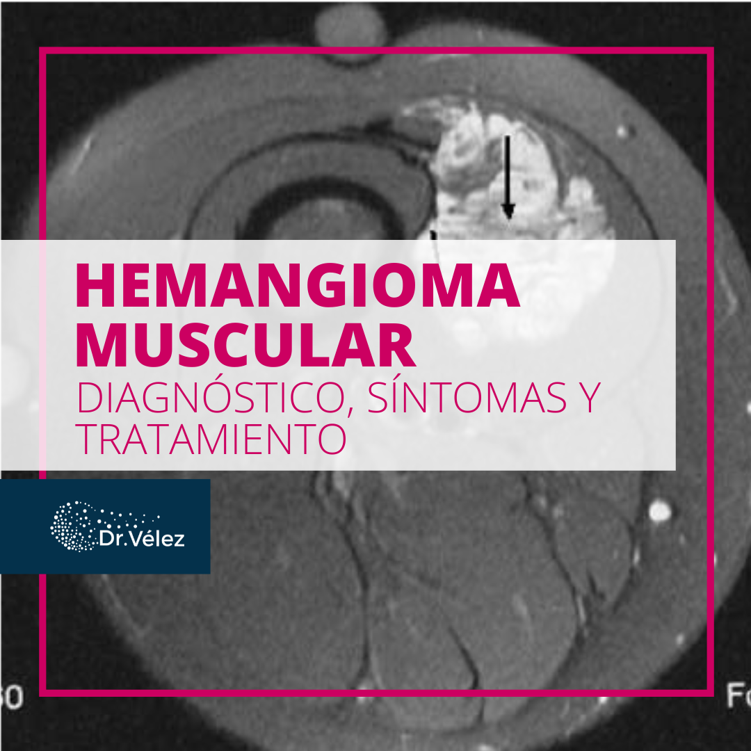 Hemangioma Muscular ¿qué Es Síntomas Y Tratamiento 0159
