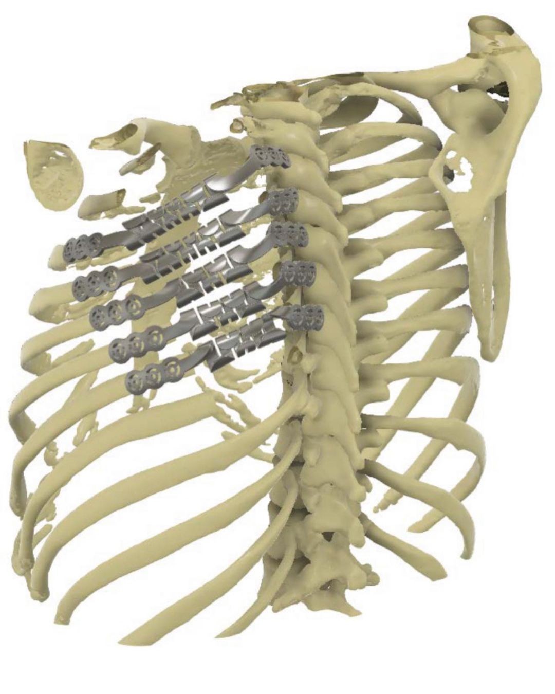 Sarcoma Fusocelular de alto grado