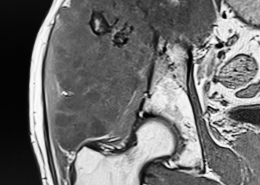 Condrosarcoma intraextrapélvico