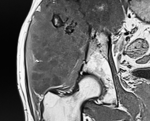 Condrosarcoma intraextrapélvico