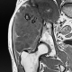 Condrosarcoma intraextrapélvico