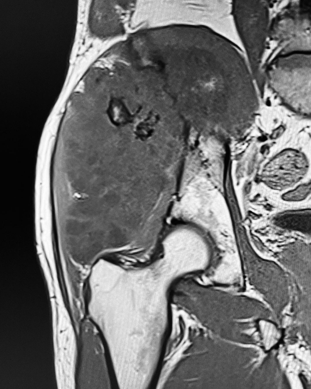 Condrosarcoma intraextrapélvico